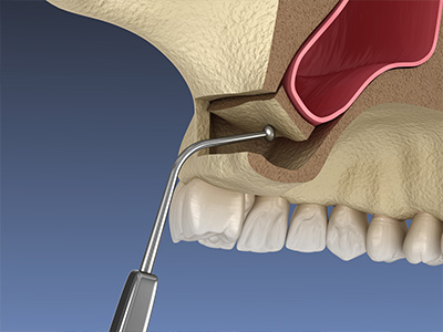 The image shows a close-up view of a dental implant installation process with a drill inserted into a tooth socket and a small tool used for adjusting the implant.