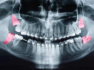 A medical X-ray image showing a skull with red markers on teeth and jaw, highlighting areas of interest.