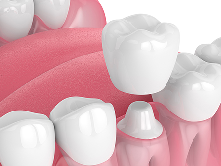 The image shows a close-up of artificial teeth with various shades of pink and white, arranged in an orderly fashion against a white background.