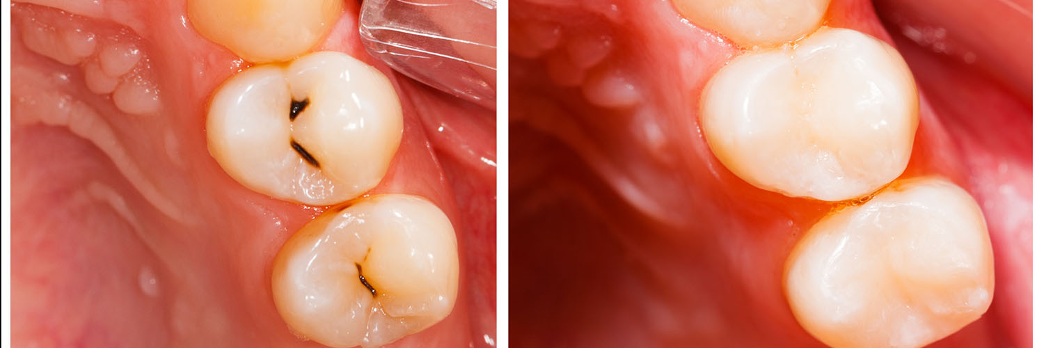 The image shows a close-up view of a tooth with dental implants, showing two different types of implants side by side  one with a screw visible through the gum line and another with the screw hidden beneath the gum line.