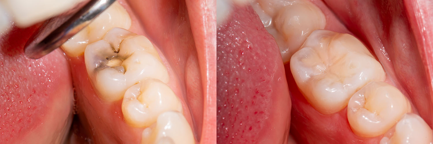 The image shows a close-up view of a mouth with teeth and gums, featuring red and white colors likely due to inflammation or medical treatment.